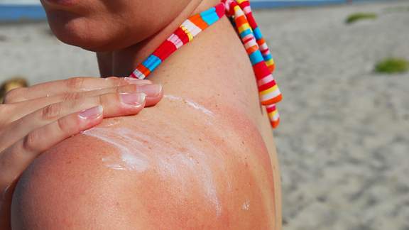 Eine Frau cremt sich die leicht verbrannte Schulter mit Sonnencreme ein